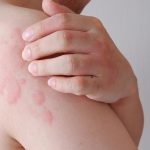 Svrbive vyrazky sa objavia v priebehu minut Chlad moze sposobit aj zivot ohrozujuce reakciu