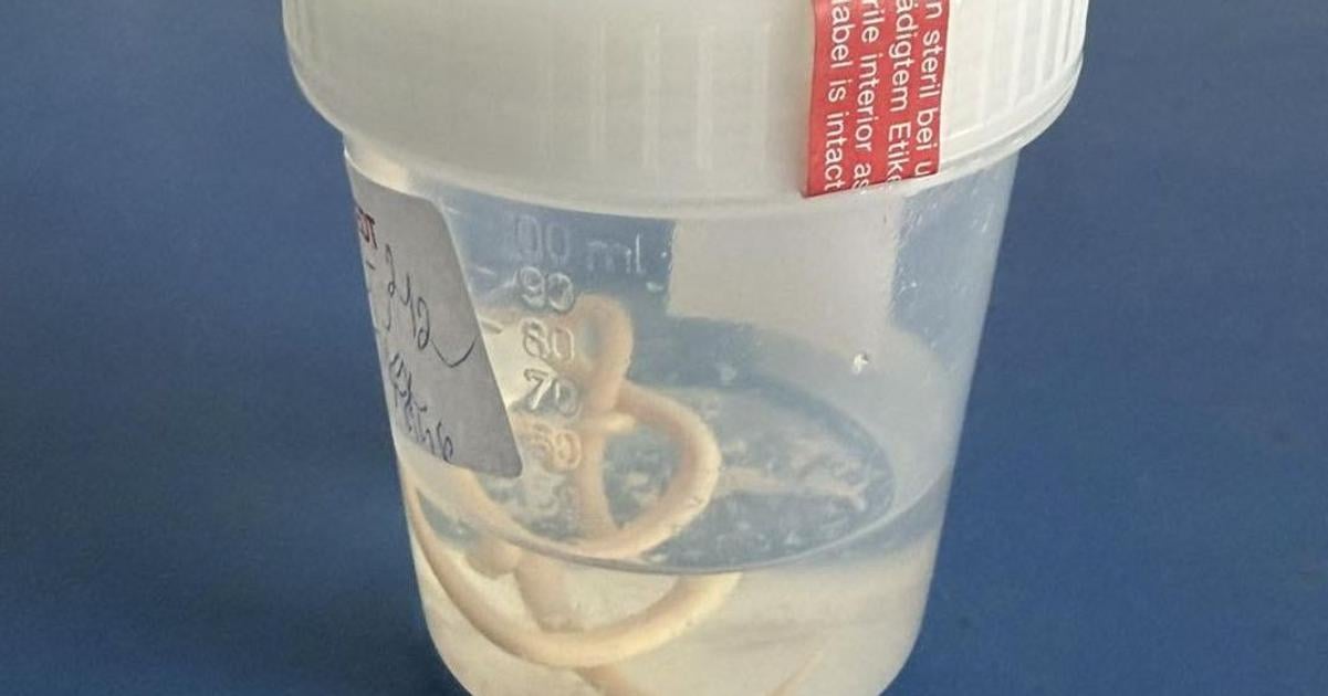 Pacient nemal infarkt ale parazita vykaslal ho na kuriozitu upozornil lekar z Nitry